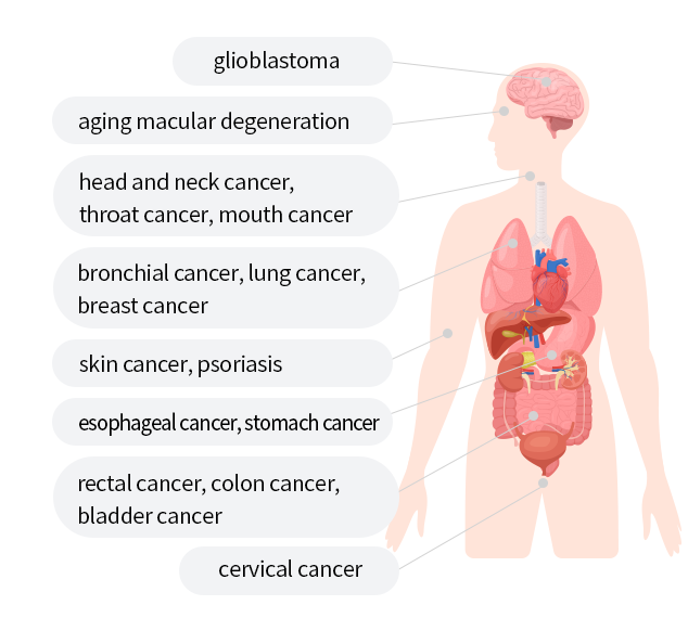 교모세포종/노화황반변성/두부경부암,인후두암,구강암/기관지암,폐암,유방암/피부암,건선/식도암,위암/직장암,대장암,방광암/자궁경부암